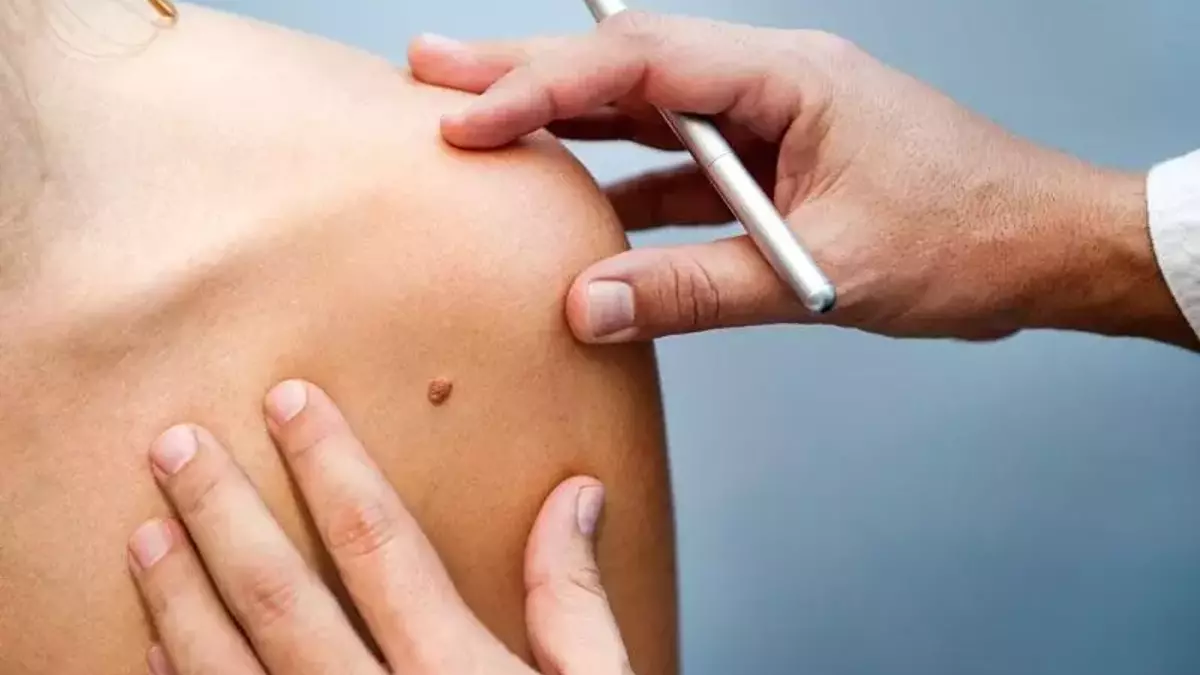 Cilt kanseri vakalarında alarm verici artış: Uzmanlar d&uuml;zenli kontrol &ccedil;ağrısı yapıyor