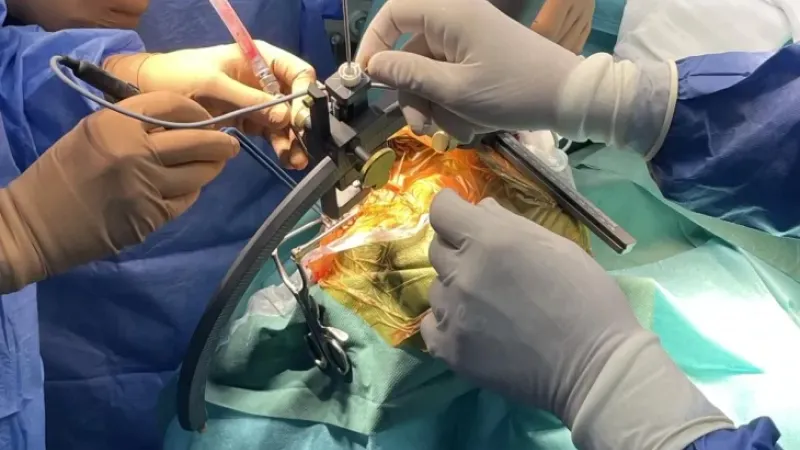 İlk çerçeveli stereotaktik beyin biyopsisi ameliyatı gerçekleşti